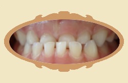 Pierwsze efekty noszenia aparatu ortodontycznego - 1 miesic - przed
