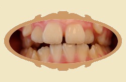 Pierwsze efekty noszenia aparatu ortodontycznego - 6 miesicy - przed