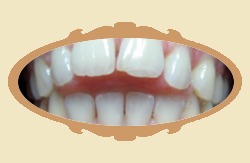przykad ortodontyczny - zgryz otwarty