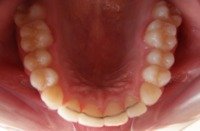 Pierwsze efekty noszenia aparatu ortodontycznego - 5 miesicy - po