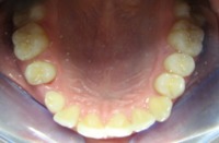 Pierwsze efekty noszenia aparatu ortodontycznego - 5 miesicy - przed