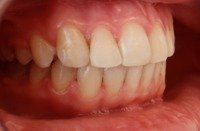 Pierwsze efekty noszenia aparatu ortodontycznego - 1 miesic - po