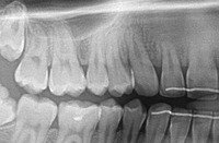 Pierwsze efekty noszenia aparatu ortodontycznego - 12 miesicy - po