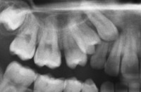 Pierwsze efekty noszenia aparatu ortodontycznego - 12 miesicy - przed
