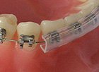 aparat ortodontyczny ruchomy 1