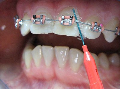 Czyszczenie zbw z aparatem ortodontycznym - wyciorek