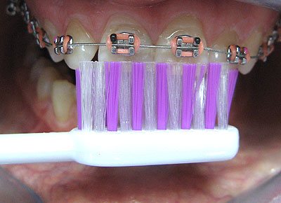 Czyszczenie zbw z aparatem ortodontycznym - specjalna szczoteczka