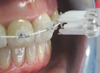 Czyszczenie zbw z aparatem ortodontycznym - specjalna szczoteczka