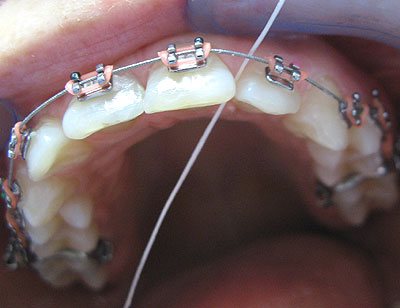 Czyszczenie zbw z aparatem ortodontycznym - nitka