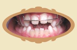 przykad ortodontyczny - zgryz otwarty