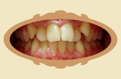 Pierwsze efekty noszenia aparatu ortodontycznego - 5 miesicy - przed