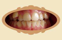 Pierwsze efekty noszenia aparatu ortodontycznego - 12 miesicy - przed