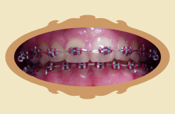 Pierwsze efekty noszenia aparatu ortodontycznego - 12 miesicy - po