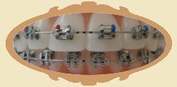 zamki metalowe do aparatw ortodontycznych