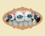zamki antyalergiczne do aparatów ortodontycznych