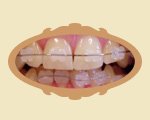 zamki ceramiczne do aparatw ortodontycznych