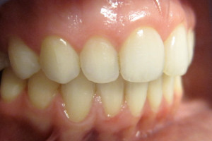 wyleczony brak kontaktu zęby dolne i górne