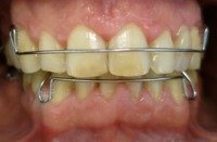 Pacjent z płytkami retencyjnymi z dostawionymi brakującymi zębami