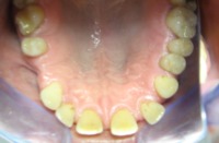 Braki zębów, szpary między zębami