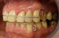Pacjent z płytkami retencyjnymi z dostawionymi brakującymi zębami
