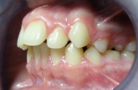 prawidłowe ustawienie zębów - wodok z przodu