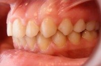 prawidłowe ustawienie zębów - wodok z boku