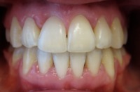 prawidłowe zachodzenie zębów