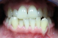 odwrotne zachodzenie zębów