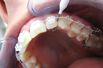 Czyszczenie zębów z aparatem ortodontycznym - wyciorek