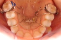 aparat ortodontyczny ruchomy 1