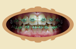 Pierwsze efekty noszenia aparatu ortodontycznego - 5 miesięcy - po