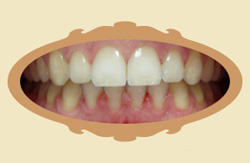 prawidłowe ustawienie zębów - wodok z przodu