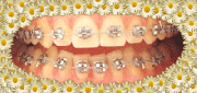 aparat ortodontyczny